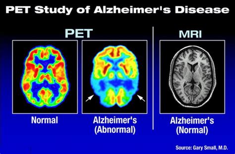 PET Scans Point Way to Better Alzheimer’s Diagnosis | Psychiatric News