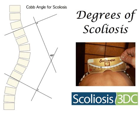 Scoliosis Angle | Degrees of Scoliosis | Cobb Angle | Scoliometer