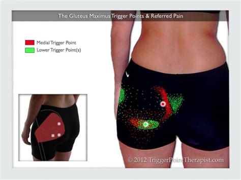 Gluteus Maximus Trigger Points: A Real Pain in the Rear End ...