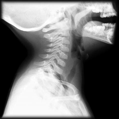 Croup - steeple sign | Image | Radiopaedia.org