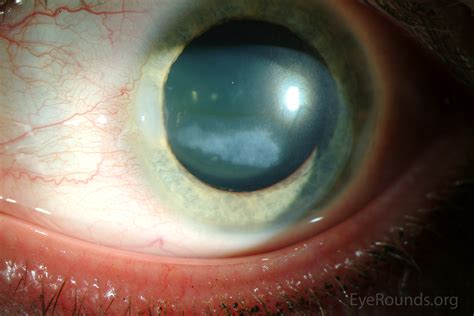 Calcific Band Keratopathy