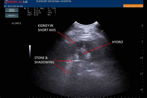 Can You See Kidney Stones With Ultrasound - HealthyKidneyClub.com