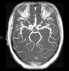 MR Angiogram - Imaging Glossary - Patients - UR Medicine Imaging Sciences (Radiology ...