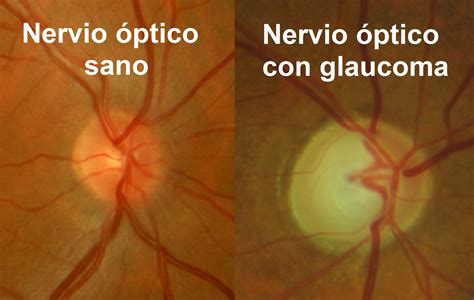 Nervio óptico Sano vs Glaucoma - Vista Camacho Oftalmólogos