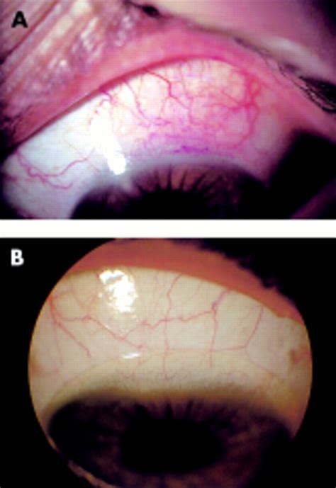 Treatment of superior limbic keratoconjunctivitis with a unilateral bandage contact lens ...