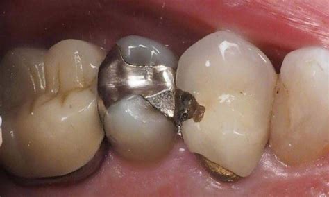 Broken Dental Crowns - A Complete Guide