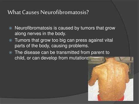 PPT - Neurofibromatosis PowerPoint Presentation, free download - ID:6597494