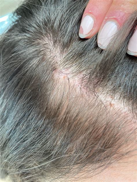 What are these red patches? : r/FemaleHairLoss