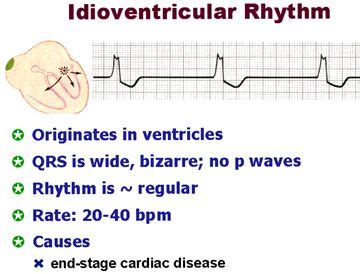 MEDICAL SCHOOL: Idioventricular rhythm,what to know? in 2020 | Rhythms, Medical school, Medical