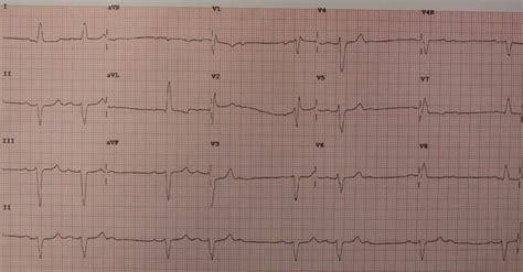 Cardiac Tamponade Ecg Changes