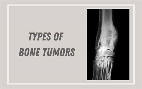 What Are The Different Types Of Bone Tumors? - Dr. Chetan Anchan