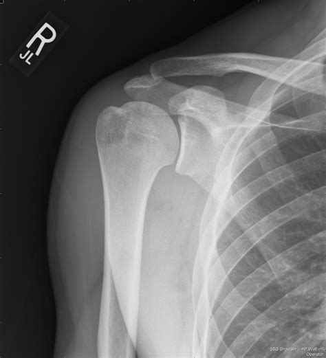 SHOULDER ARTHRITIS | Buyxraysonline