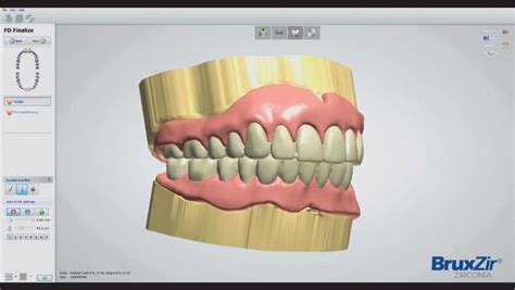 3D-Printed Immediate Dentures: Advantages Explained