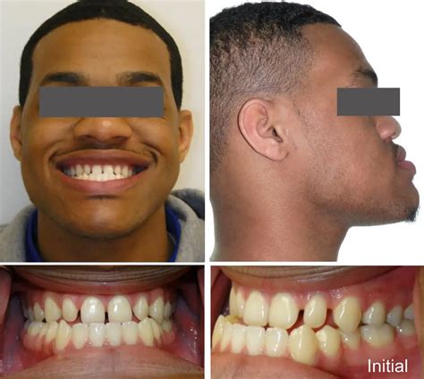 Crossbite Treatment Options: Braces, Invisalign, and More