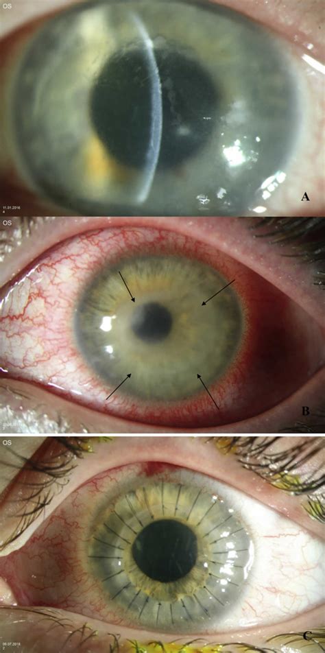 Acanthamoeba keratitis causes, signs, symptoms, diagnosis, treatment & prognosis