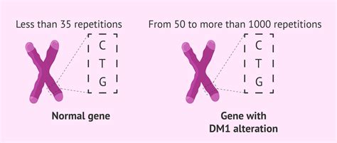 Steinert's myotonic dystrophy - Symptoms, diagnosis and treatment