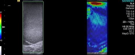 Figure 2 from Evaluation of Giant Galactocele With Ultrasound and Shearwave Elastography ...