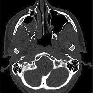 Right zygomaticomaxillary complex fracture in a 39-year old Belarusian ...