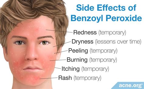 Everything You Need to Know About Benzoyl Peroxide - Acne.org