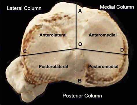 Three-Column Classification System for Tibial Plateau Fractures: What the Orthopedic Surgeon ...