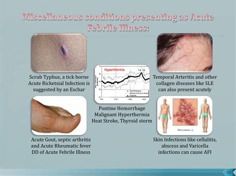 PPT - Description of Acute Febrile Illness PowerPoint Presentation, free download - ID:1360001