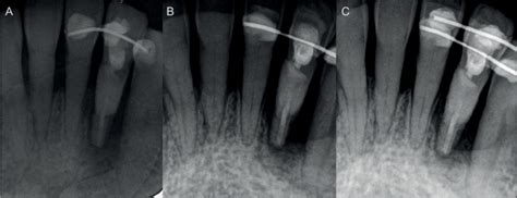 Intentional replantation for periodontally involved hopeless teeth... | Download Scientific Diagram