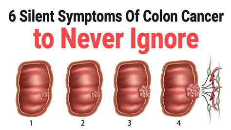 6 Silent Symptoms Of Colon Cancer to Never Ignore - Health Queen