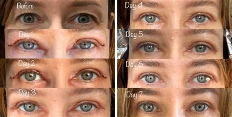 Upper Blepharoplasty Before and After Gallery | Taban MD