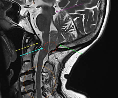 Arnold Chiari Type I Malformation | C.N.S. Neurosurgery