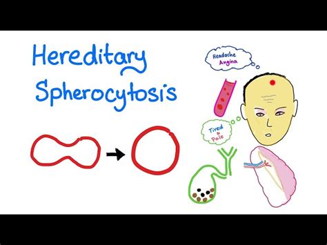 Hereditary Spherocytosis – SKILLMD