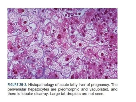 Liver disease in pregnancy | PPT