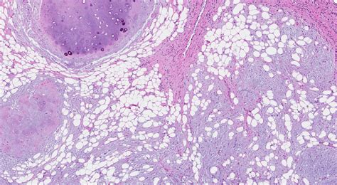 Hamartoma | MyPathologyReport.ca