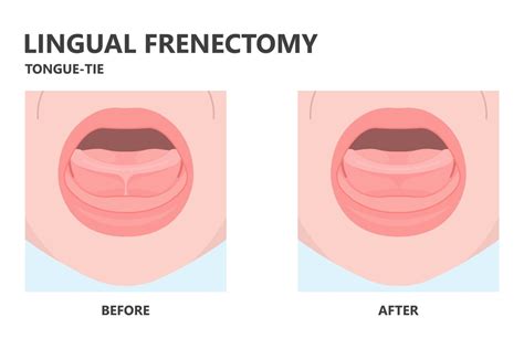 Does My Child Need a Lingual Frenectomy? - Smile Explorers