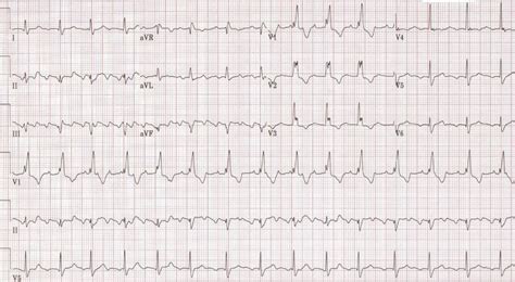 Atrial flutter EKG examples - wikidoc