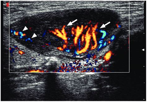 Directional power Doppler sonogram showing a lymphomatous lymph node... | Download Scientific ...