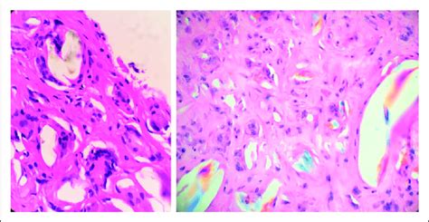 Histopathology showing significant multinucleated giant cell foreign... | Download Scientific ...