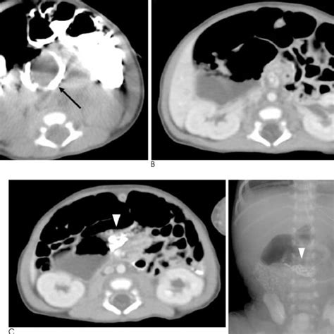 (PDF) Various Imaging Features of Intestinal Malrotation, Associated ...