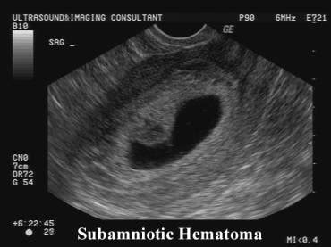 Placental Hemorrhage Ultrasound