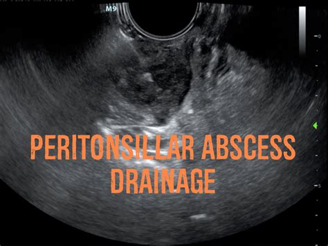 Hennepin Ultrasound | Peritonsillar Abscess Drainage