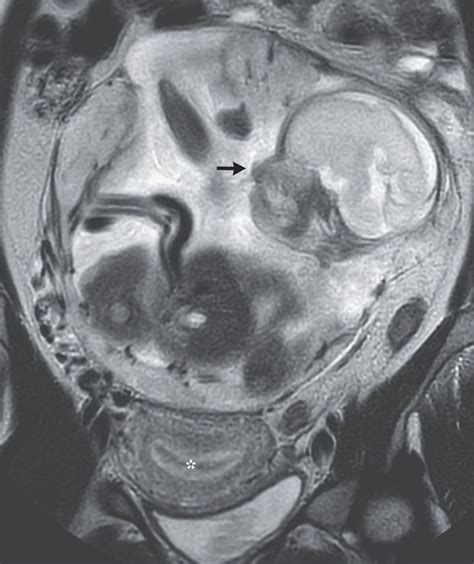 Abdominal Ectopic Pregnancy - MEDizzy