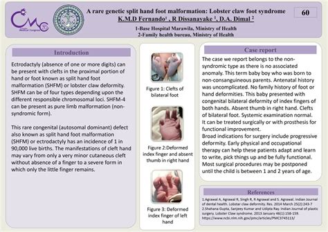 (PDF) Split hand malformation: Lobster Claw syndrome