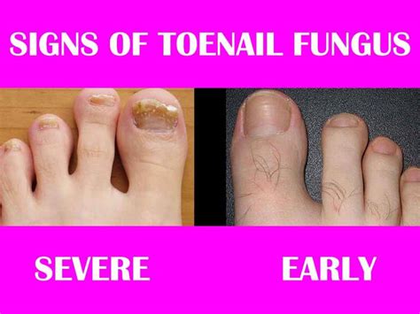 Toenail Fungus Blog – My Clean Nails