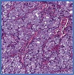 acinic-cell-carcinoma-photomicrograph | WesternU Health