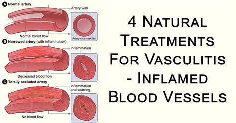 4 Natural Treatments For Vasculitis - Inflamed Blood Vessels ...