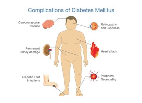 Type 1 Diabetes Heart Disease - Captions Trend