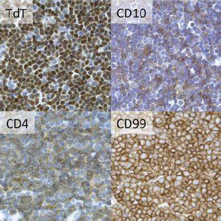 Immunophenotype and staining pattern of a case of indolent... | Download Scientific Diagram