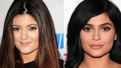 Kylie Jenner Before and After (What She Really Looks Like) - TSC