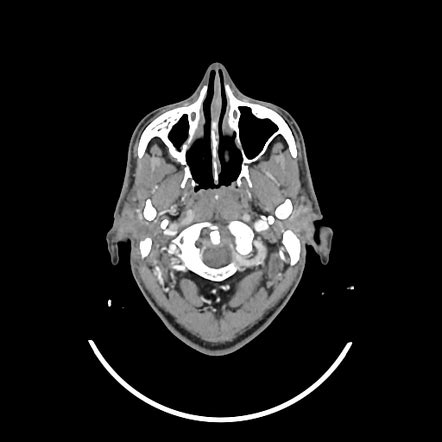 Maxillary odontogenic keratocyst | Radiology Case | Radiopaedia.org