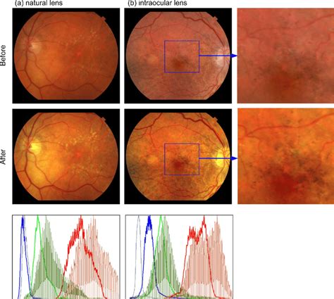 Comparison of the tonal properties of a phakic eye and a pseudophakic... | Download Scientific ...