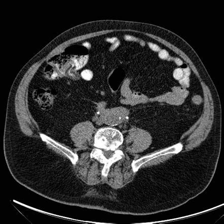 Retroperitoneal Fibrosis